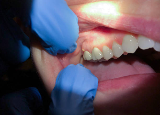 Best Emergency Tooth Extraction in Brady, TX